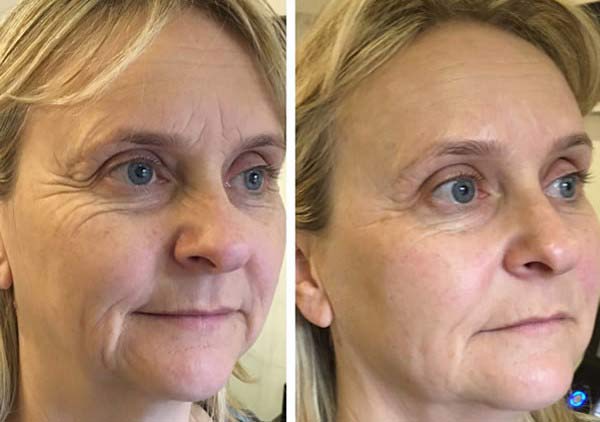 جوانسازی پوست در اصفهان 