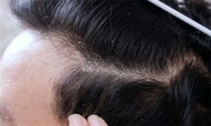 ویژگی‌ و قیمت بهترین شامپو ضد شوره برای آقایان