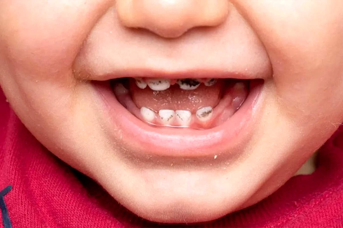 پوسیدگی دندان شیری؛ آیا واقعا درمان آن ضروری است؟
